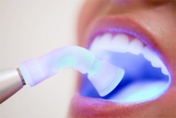 Laser Teeth Bleaching